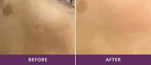 PIGMENTATION REMOVAL