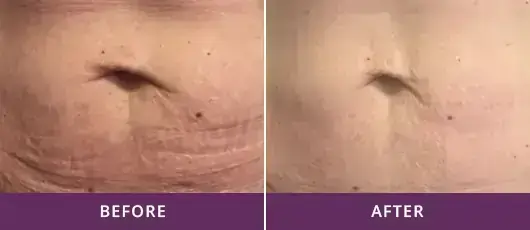 SKIN TIGHTENING