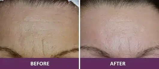 Wrinkle Reduction