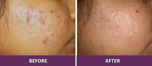 Skin Resurfacing