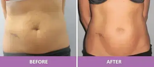 BODY CONTOURING