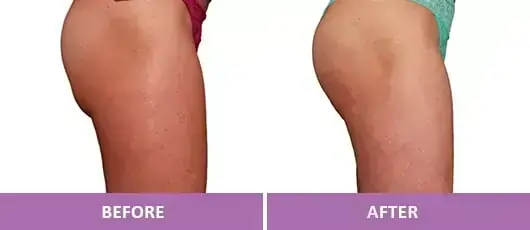 CELLULITE TREATMENT