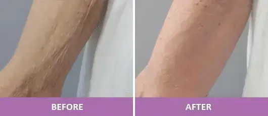 SKIN TIGHTENING