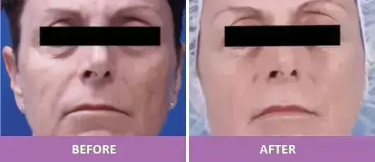 WRINKLE REDUCTION