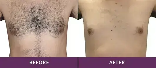 PERMANENT HAIR REMOVAL