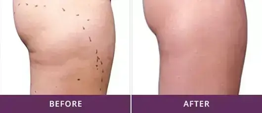 BODY CONTOURING