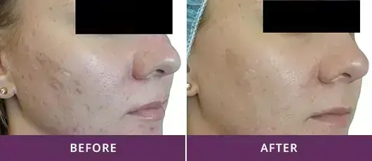 SKIN RESURFACING