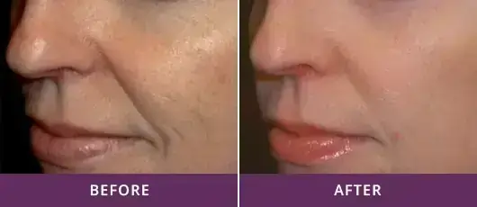 WRINKLE REDUCTION