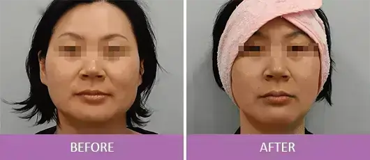 Non-Invasive FaceLift