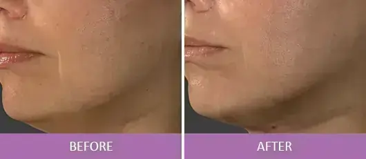 Skin Tightening