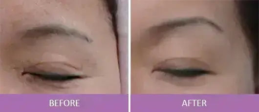 Wrinkle Reduction