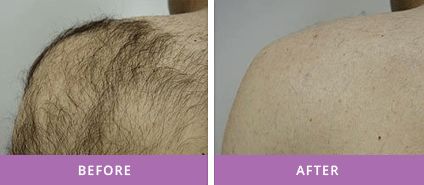 PERMANENT HAIR REMOVAL