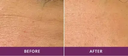 SKIN REJUVENATION