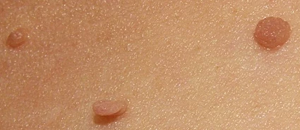 Removal of Skin Tags and Warts