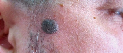 Seborrheic Keratosis Removal