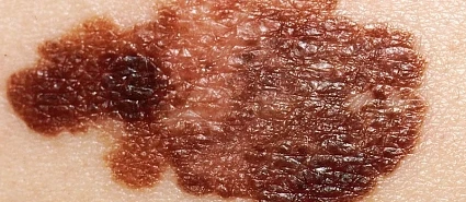 Treatment of Skin Cancers