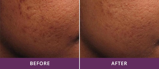 ACNE SCAR REDUCTION