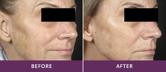 NEEDLE-FREE WRINKLE REDUCTION