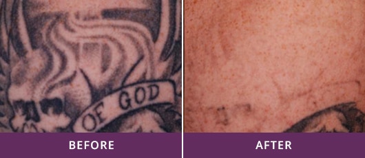 TATTOO REMOVAL OF ALL COLORS