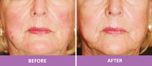 ROSACEA TREATMENT