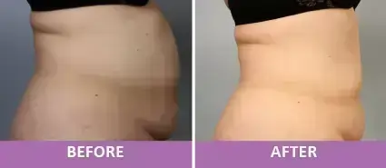 Body Contouring