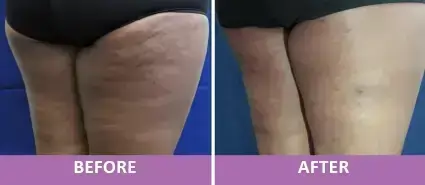 Cellulite Reduction 