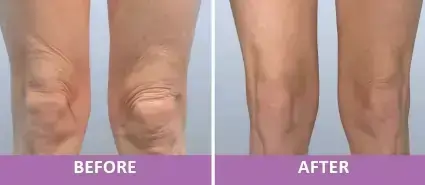 Wrinkle Reduction