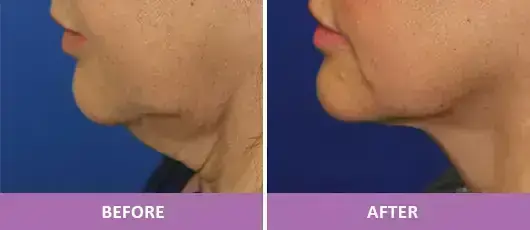 SKIN TIGHTENING