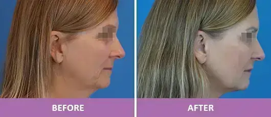 WRINKLE REDUCTION