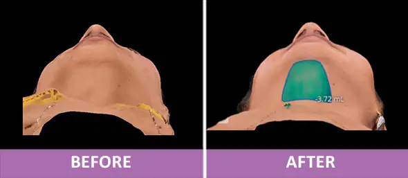 FACIAL CONTOURING