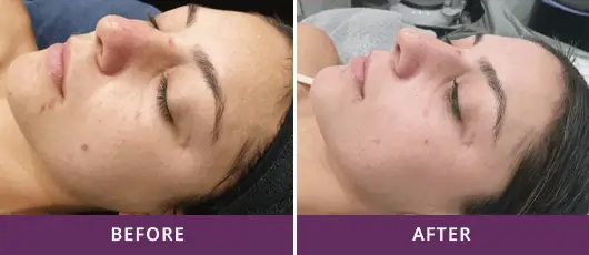 Acne Treatment 