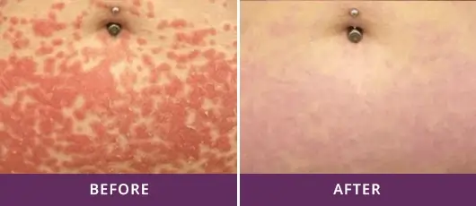 Psoriasis Treatment 