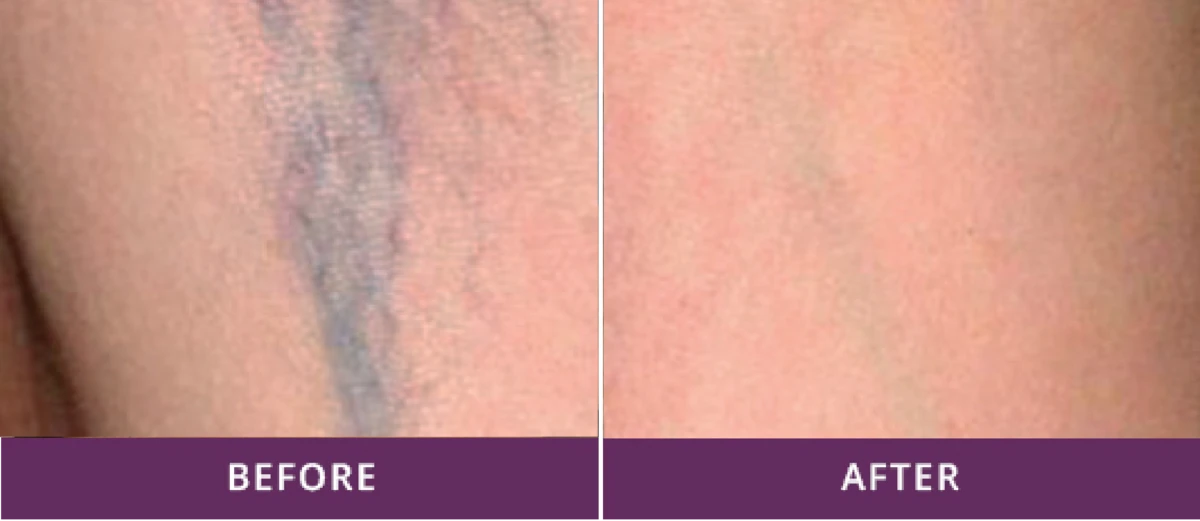 Vascular Lesions Treatment