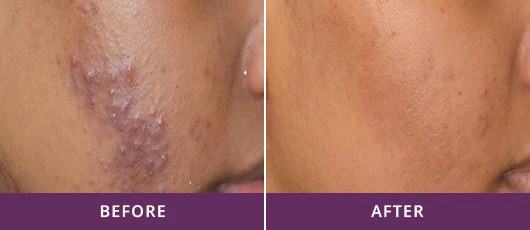 TREATMENT OF ACNE AND ACNE SCARS