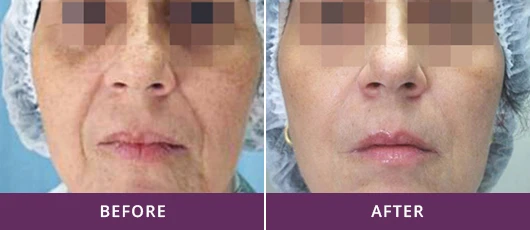 SKIN REMODELING AND LIFTING