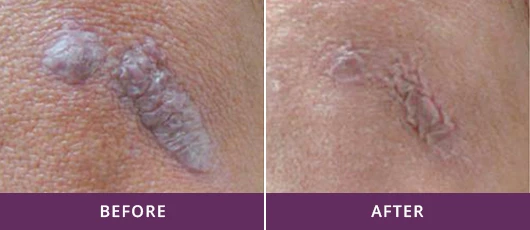 SKIN RESURFACING PROCEDURE