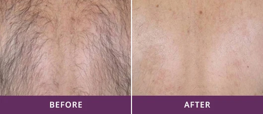 PERMANENT HAIR REMOVAL