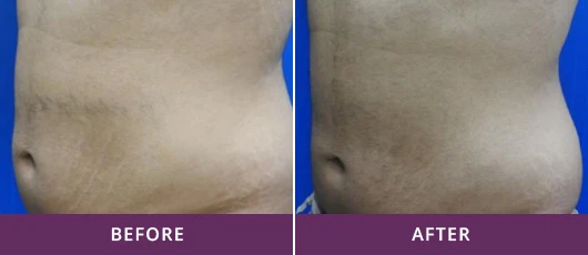 BODY AND FACE CONTOURING