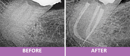 Endodontics Treatment