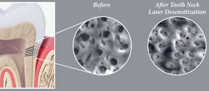 Periodontitis Treatment