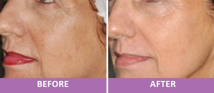 SKIN REJUVENATION