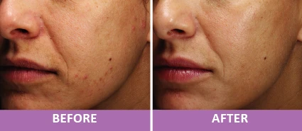 SKIN RESURFACING