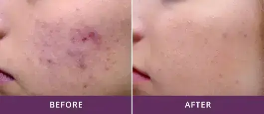 ACTIVE ACNE AND ACNE SCAR TREATMENT