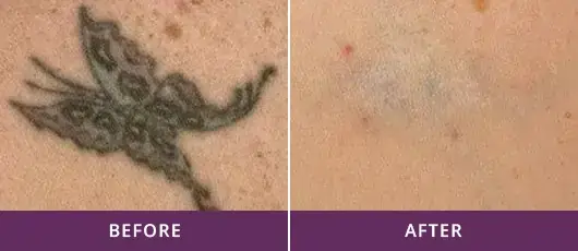 TATTOO REMOVAL