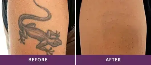 Tattoo Removal 