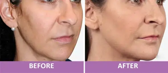 Non-Invasive FaceLift