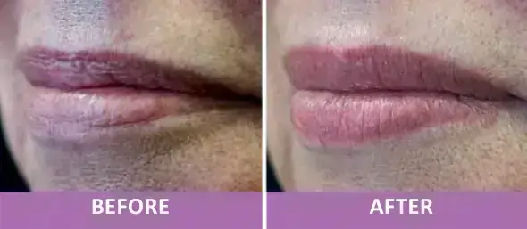 Non-Invasive Lip Plumping