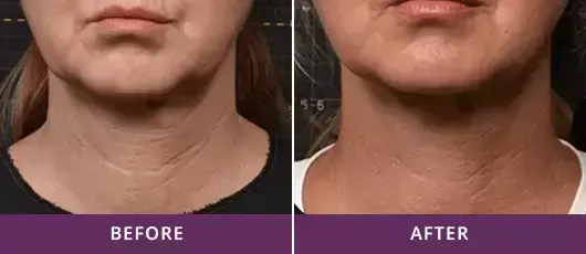 Smoother Neck
