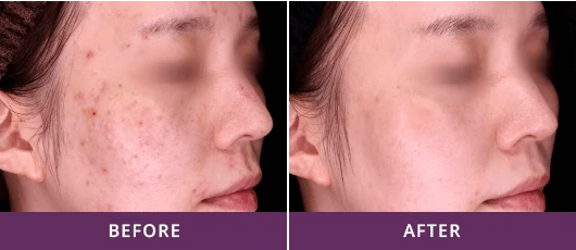 Acne Spots Clearance 