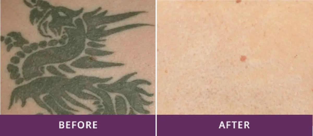 Tattoo Removal 